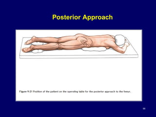 Posterior Approach
66
 