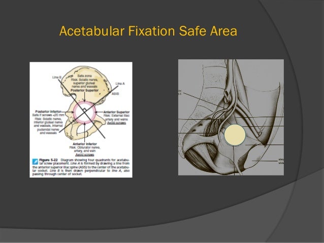 Total Hip Arthroplasty Anatomy