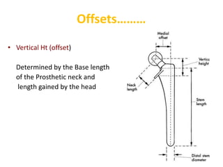 Left Helical Offset Hip biomechanics | PPTX