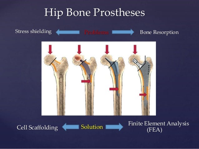 Hip bone prostheses