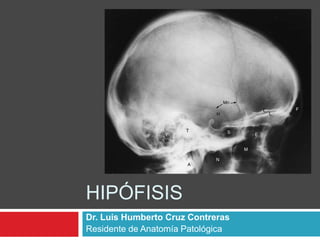HIPÓFISIS
Dr. Luis Humberto Cruz Contreras
Residente de Anatomía Patológica
 