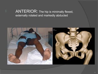  ANTERIOR: The hip is minimally flexed, 
externally rotated and markedly abducted 
10 
 
