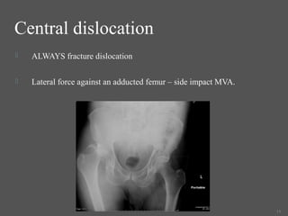Central dislocation 
 ALWAYS fracture dislocation 
 Lateral force against an adducted femur – side impact MVA. 
11 
 