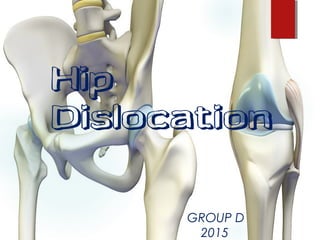 Hip
Dislocation
GROUP D
2015
 