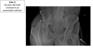Adult Orthopedic Imaging Series: Presentation #2 Native Hip ...