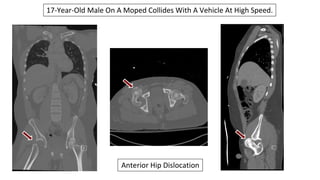 Adult Orthopedic Imaging Series: Presentation #2 Native Hip ...