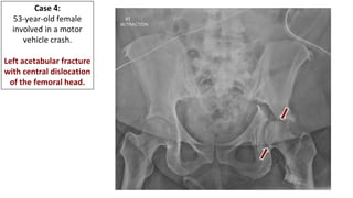 Adult Orthopedic Imaging Series: Presentation #2 Native Hip ...