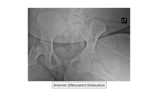 Adult Orthopedic Imaging Series: Presentation #2 Native Hip ...