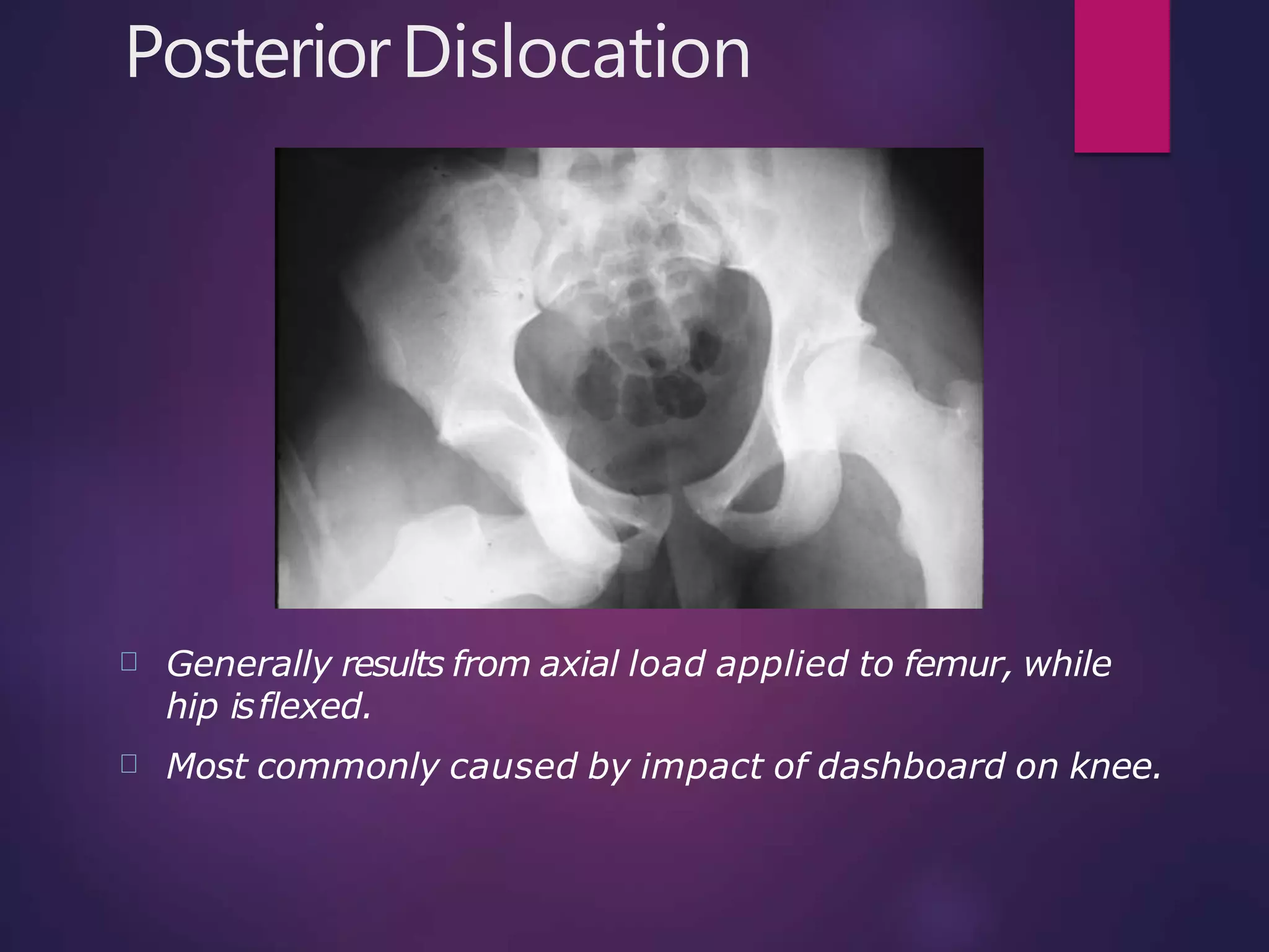 Hip dislocation | PPTX