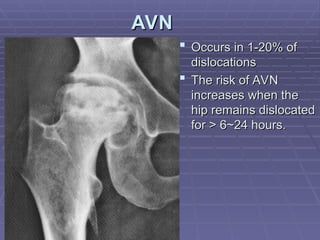 Traumatic Dislocations of the Hip Medical Presentation | PPT