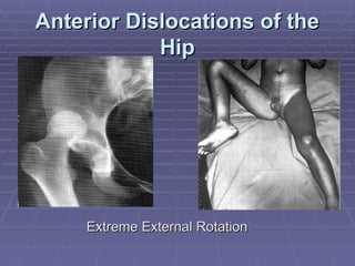 Traumatic Dislocations of the Hip Medical Presentation | PPT