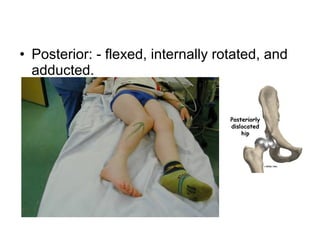 • Posterior: - flexed, internally rotated, and
adducted.

 