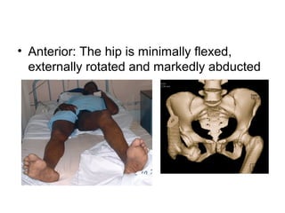 • Anterior: The hip is minimally flexed,
externally rotated and markedly abducted

 