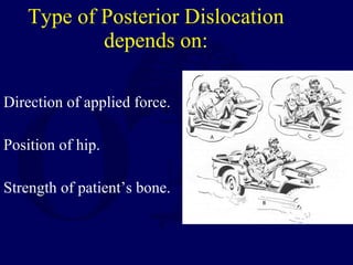 Type of Posterior Dislocation depends on: <ul><li>Direction of applied force. </li></ul><ul><li>Position of hip. </li></ul...