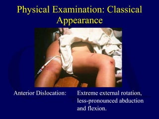 Physical Examination: Classical Appearance <ul><li>Anterior Dislocation:  Extreme external rotation,  </li></ul><ul><li>le...