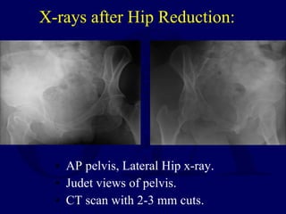 X-rays after Hip Reduction: <ul><li>AP pelvis, Lateral Hip x-ray. </li></ul><ul><li>Judet views of pelvis. </li></ul><ul><...