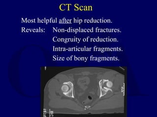 CT Scan <ul><li>Most helpful  after  hip reduction. </li></ul><ul><li>Reveals: Non-displaced fractures. </li></ul><ul><li>...