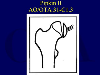 Pipkin II AO/OTA 31-C1.3 