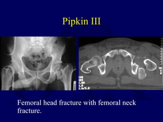 Pipkin III <ul><li>Femoral head fracture with femoral neck fracture. </li></ul>