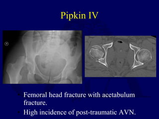 Pipkin IV <ul><li>Femoral head fracture with acetabulum fracture. </li></ul><ul><li>High incidence of post-traumatic AVN. ...