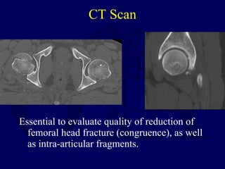 CT Scan <ul><li>Essential to evaluate quality of reduction of femoral head fracture (congruence), as well as intra-articul...