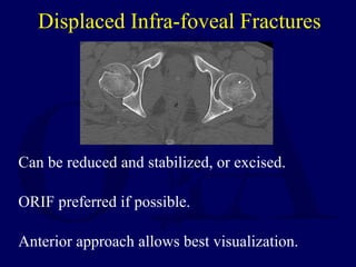 Displaced Infra-foveal Fractures <ul><li>Can be reduced and stabilized, or excised. </li></ul><ul><li>ORIF preferred if po...