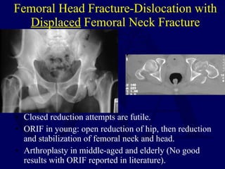 Femoral Head Fracture-Dislocation with  Displaced  Femoral Neck Fracture <ul><li>Closed reduction attempts are futile. </l...