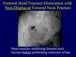 Femoral Head Fracture-Dislocation with  Non-Displaced  Femoral Neck Fracture <ul><li>Must consider stabilizing femoral nec...