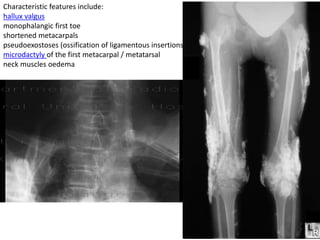 Microdactaly Hip dysplesia ppt | PPTX