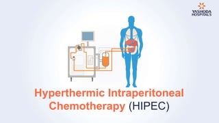 Hyperthermic Intraperitoneal
Chemotherapy (HIPEC)
 