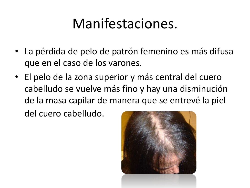 Hiperandrogenismo