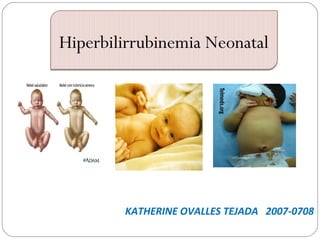 Hiperbilirrubinemia Neonatal




        KATHERINE OVALLES TEJADA 2007-0708
 