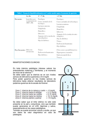 MANIFESTACIONES CLINICAS
En toda ictericia patológica interesa valorar los
antecedentes maternos y familiares, y el momento
de inicio de la ictericia (2)
Se debe saber que la ictericia se ve con niveles
sericos de bilirrubina superiores a 4-5 mg/dl.
Para poder guiarnos en los niveles sericos de
bilirrubina hasta obtener resultados de laboratorio
podemos guiarnos de la escala de Kramer:
Se debe saber que el tinte ictérico no sólo está
presente en la piel y conjuntivas, sino que también
puede apreciarse en el LCR, lágrimas y saliva,
especialmente en los casos patológicos.
También se puede encontrar coluria y acolia, ya que
son datos de valor diagnóstico en caso de
patologías.
 