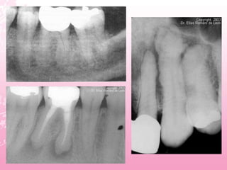 Hypercementosis Radiographic Hipercementosis y cementiculos | PPTX