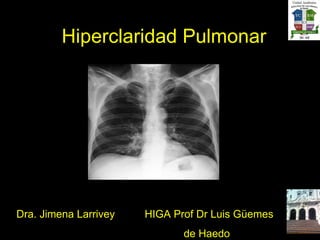 Hiperclaridad Pulmonar Dra. Jimena Larrivey  HIGA Prof Dr Luis Güemes de Haedo  