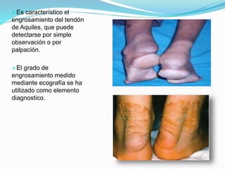 Es característico el
engrosamiento del tendón
de Aquiles, que puede
detectarse por simple
observación o por
palpación.
El grado de
engrosamiento medido
mediante ecografía se ha
utilizado como elemento
diagnostico.
 