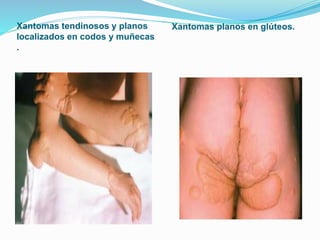 Xantomas tendinosos y planos
localizados en codos y muñecas
.
Xantomas planos en glúteos.
 