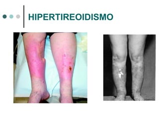 HIPERTIREOIDISMO 