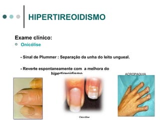 HIPERTIREOIDISMO Exame clínico: Onicólise  - Sinal de Plummer : Separação da unha do leito ungueal. - Reverte espontaneamente com  a melhora do  hipertireoidismo. ACROPAQUIA 