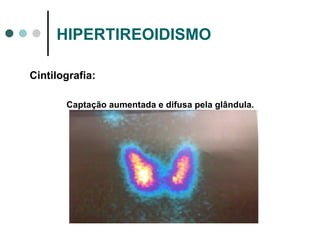 HIPERTIREOIDISMO Cintilografia:  Captação aumentada e difusa pela glândula. 