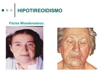 HIPOTIREOIDISMO Fácies Mixedematosa: 