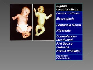 Signos
característicos
Facies cretinica
Macroglosia

Fontanela Menor
Hipotonia
Somnolencia-
Inactividad
Piel Seca y
moteada
Hernia umbilical
Inapetencia
Estreñimiento
 