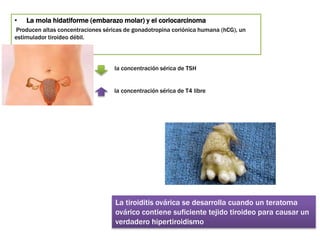 • La mola hidatiforme (embarazo molar) y el coriocarcinoma
Producen altas concentraciones séricas de gonadotropina coriónica humana (hCG), un
estimulador tiroideo débil.
La tiroiditis ovárica se desarrolla cuando un teratoma
ovárico contiene suficiente tejido tiroideo para causar un
verdadero hipertiroidismo
la concentración sérica de TSH
la concentración sérica de T4 libre
 