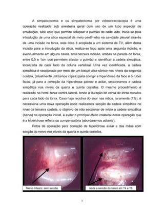 A simpaticotomia e ou simpatectomia por videotoracoscopia é uma
operação realizada sob anestesia geral com uso de um tubo especial de
entubação, tubo este que permite colapsar o pulmão de cada lado. Inicia-se pela
introdução de uma ótica especial de meio centímetro na cavidade pleural através
de uma incisão no tórax, esta ótica é acoplada a um sistema de TV, além desta
incisão para a introdução da ótica, realiza-se logo após uma segunda incisão, e
eventualmente em alguns casos, uma terceira incisão, ambas na parede do tórax,
entre 0,5 e 1cm que permitem afastar o pulmão e identificar a cadeia simpática,
localizada de cada lado da coluna vertebral. Uma vez identificada, a cadeia
simpática é seccionada por meio de um bisturi ultra-sônico nos níveis da segunda
costela, (atualmente utilizamos clipes) para corrigir a hiperidrose da face e o rubor
facial; já para a correção da hiperidrose palmar e axilar, seccionamos a cadeia
simpática nos níveis da quarta e quinta costelas. O mesmo procedimento é
realizado no hemi–tórax contra lateral, tendo a duração de cerca de trinta minutos
para cada lado do tórax. Caso haja recidiva do suor nas mãos, raramente (1%), é
necessária uma nova operação onde realizamos secção da cadeia simpática no
nível da terceira costela, o objetivo de não seccionar de início a cadeia simpática
(nervo) na operação inicial, é evitar o principal efeito colateral desta operação que
é a hiperidrose reflexa ou compensatória (abordaremos adiante).
      Fotos da operação para correção da hiperidrose axilar e das mãos com
secção do nervo nos níveis da quarta e quinta costelas.




      Para a retirada d

  Nervo íntegro, sem secção                    Após a secção do nervo em T4 e T5



                                          3
 