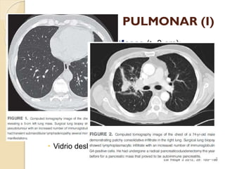 PARÉNQUIMA PULMONAR (I)


Nódulos (≤ 3 cm) / Masas (> 3 cm):
◦ Sólidos / Vidrio deslustrado.
◦ Tamaño:
 < 1 cm - > 5 cm....
