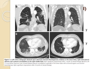 PARÉNQUIMA PULMONAR (II)


EPID:
◦ TCAR:

 Vidrio deslustrado en campos superiores y
medios + panilización.
 Opacidades...