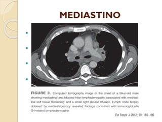 MEDIASTINO


El compartimento más afectado.



Adenopatías hiliares (90%).



Adenopatías mediastínicas (40 %).



Fib...
