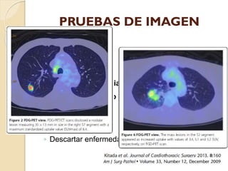 PRUEBAS DE IMAGEN


TC:
◦ Nódulos sólidos
◦ Broncovascular

◦ Infiltrado intersticial / alveolar
◦ Vidrio deslustrado


...