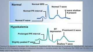 Desequilibrio Hidroelectrolitico Hiperkalemia E Hipokalemia pptx
