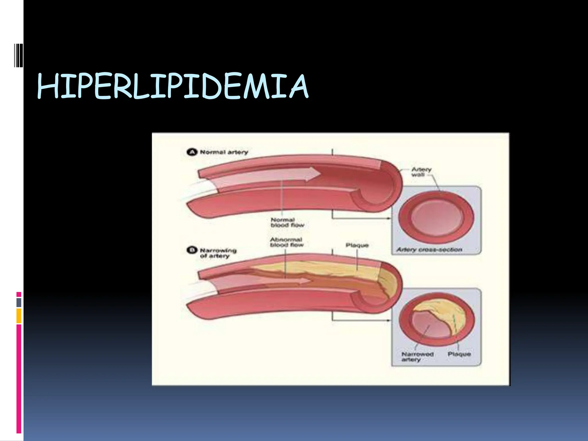 HIPERLIPIDEMIA
 